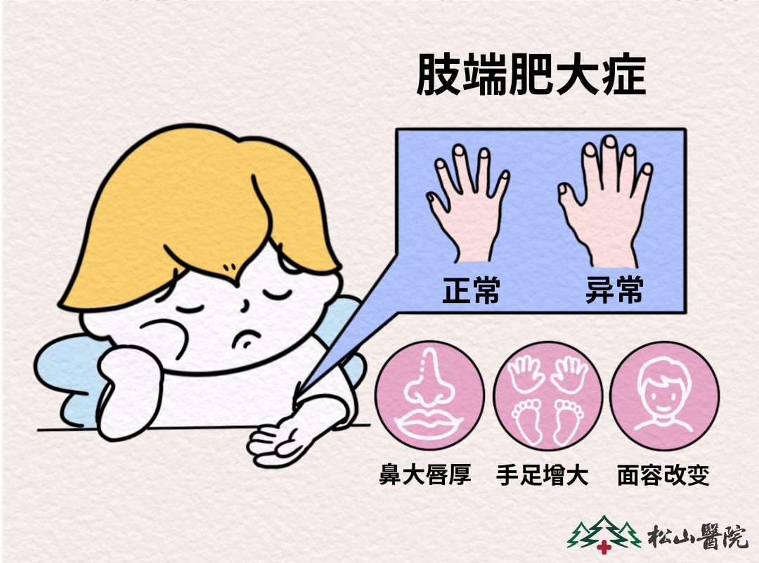 肢端肥大癥癥狀表現。重慶松山醫院供圖