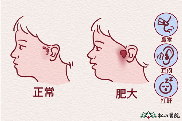 腺樣體肥大。重慶松山醫院供圖