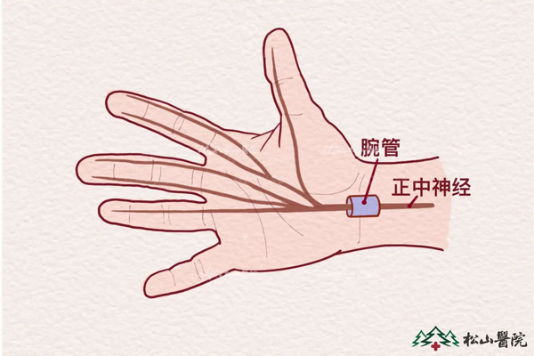 腕管綜合征。重慶松山醫院供圖
