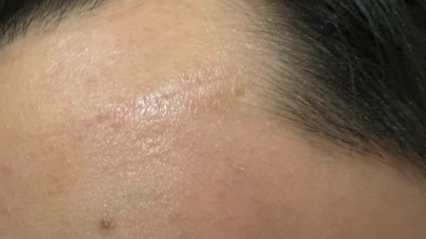 美容縫合術后6周。重慶松山醫院供圖