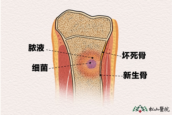 骨髓炎示意圖。重慶松山醫院供圖
