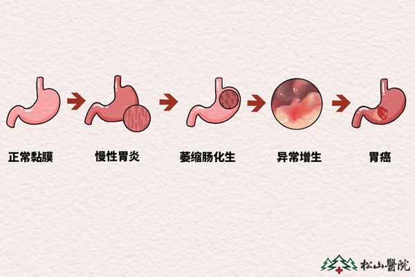 胃癌發展進程。重慶松山醫院供圖