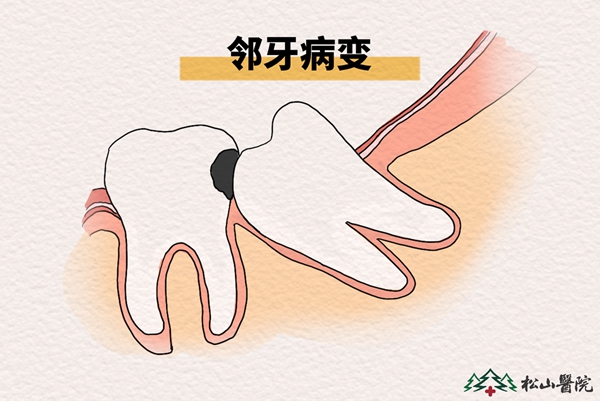 鄰牙病變。重慶松山醫院供圖