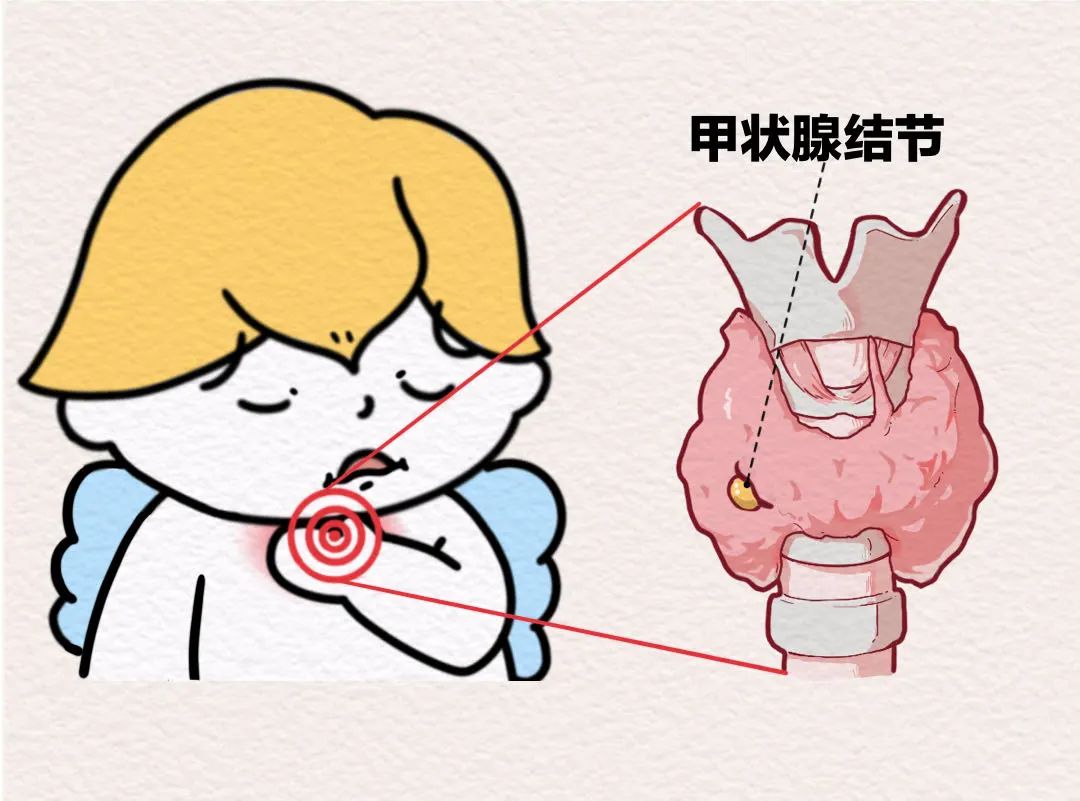 甲狀腺結節。重慶松山醫院供圖