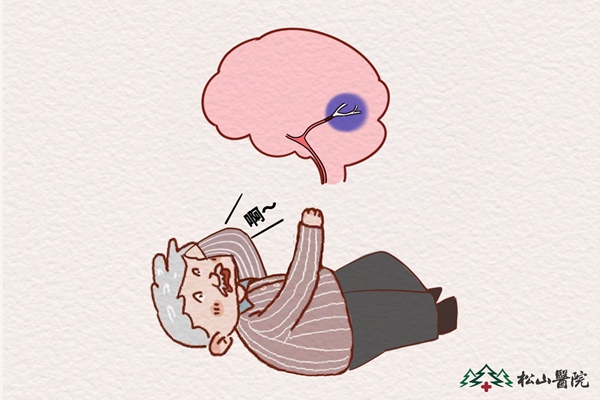 腦卒中。重慶松山醫院供圖