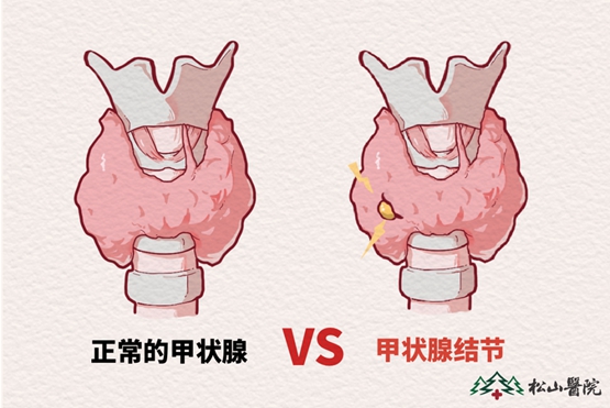 甲狀腺。重慶松山醫院供圖
