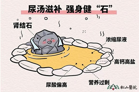 腎結石。重慶松山醫院供圖