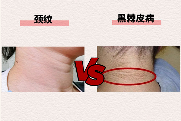 頸紋和黑棘皮病的區別。重慶松山醫院供圖