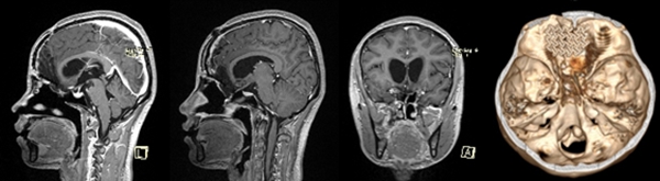 從術后磁共振和CT檢查看到，腫瘤已經被全切，腦組織恢復很完美，顱底使用鈦板修復。重慶醫科大學附屬第二醫院供圖