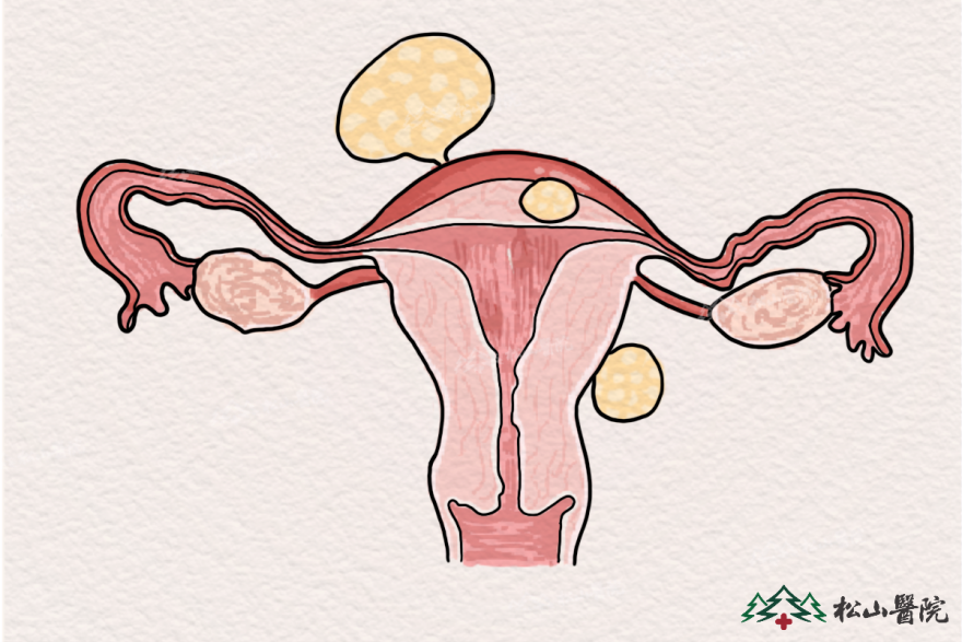子宮肌瘤。重慶松山醫院供圖