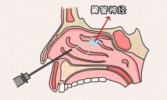 示意圖。重慶松山醫院供圖